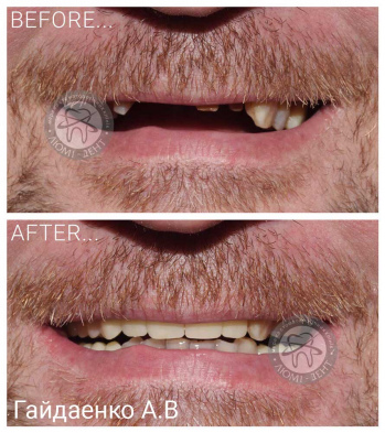 dental prosthesis