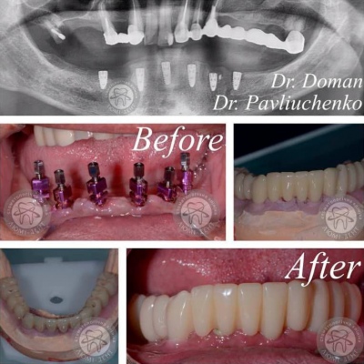 dental prosthesis