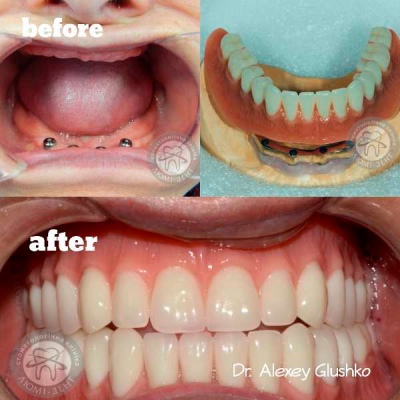 dental prosthesis