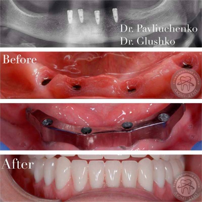 dental prosthesis