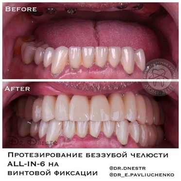 dental prosthesis