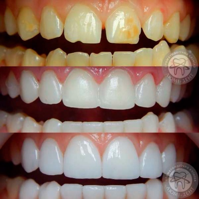 dental prosthesis