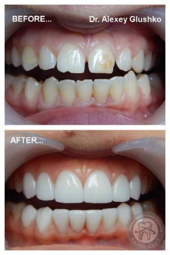 dental prosthesis