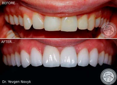 dental prosthesis