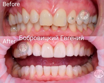 dental prosthesis