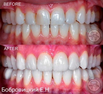 dental prosthesis