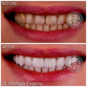 dental prosthesis