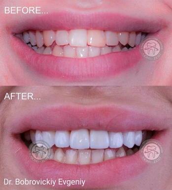 dental prosthesis