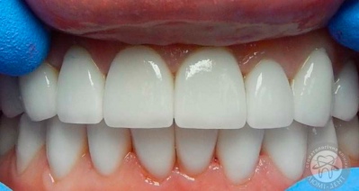 dental prosthesis