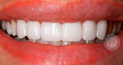 dental prosthesis