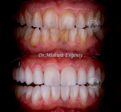 dental prosthesis