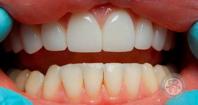 dental prosthesis