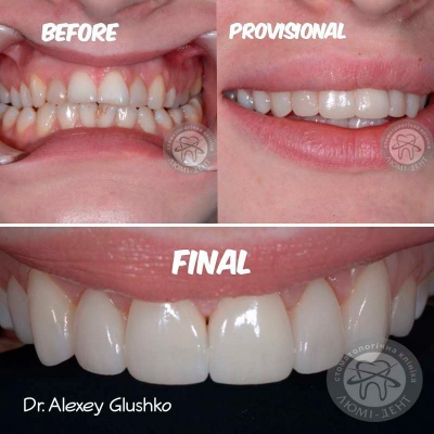 dental prosthesis