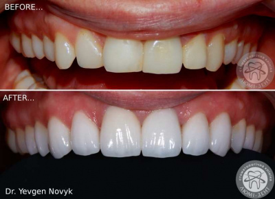 протезування зубів київ, фото, до і після