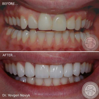 dental prosthesis