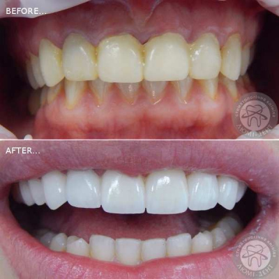dental prosthesis