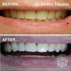 отбеливание зубов киев, фото, до и после