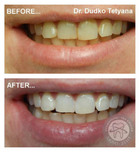 отбеливание зубов киев, фото, до и после Люмидент
