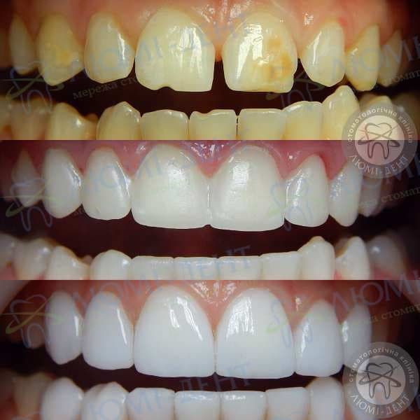 Керамічні зуби коронки фото Люмі-Дент