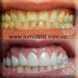 Керамические Виниры на зубы фото до и после Киев цена Люмидент
