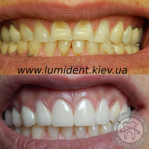 Керамические Виниры на зубы фото до и после Киев цена Люмидент
