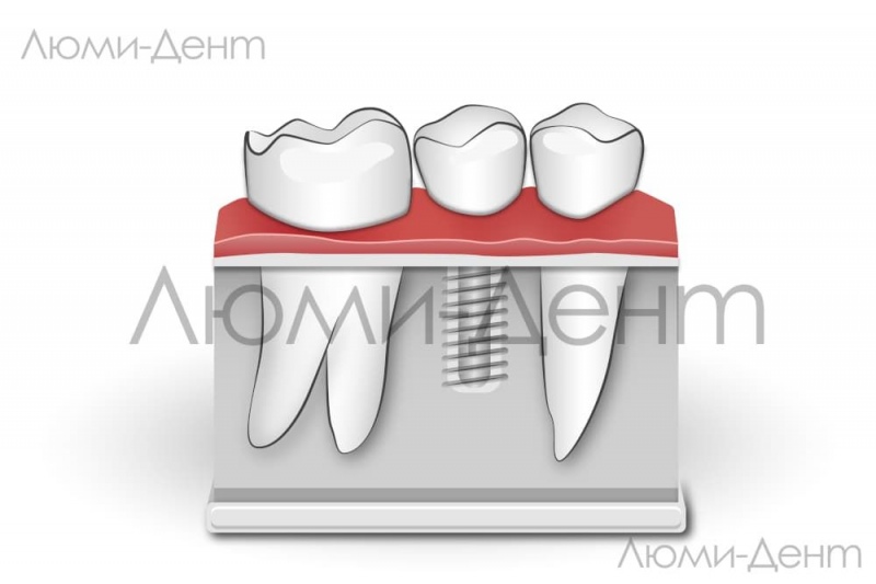 Одномоментная Базальная Имплантация зубов Киев Люми-Дент