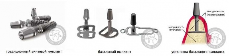 Классические и базальные зубные импланты