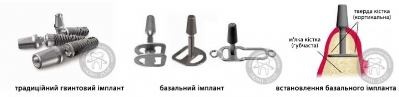 Класичні та базальні зубні імпланти