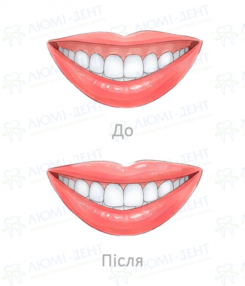 До та після корекції Gummy Smile Корекція Gummy Smile у Києві фото Люмі-Дент