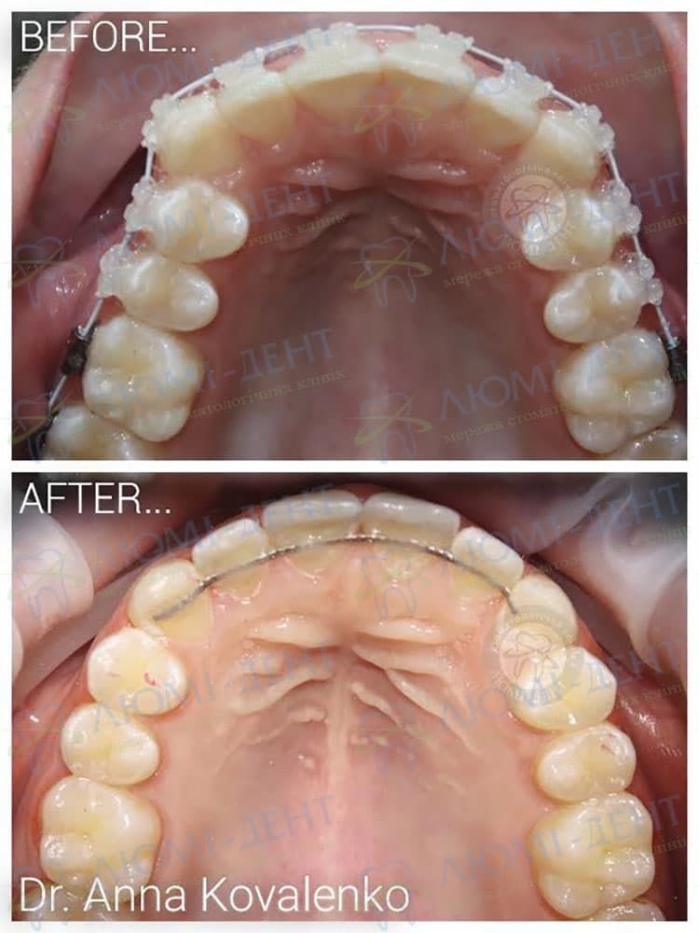 Брекет системы фото Люми-Дент