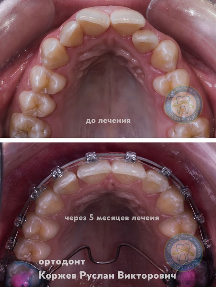 Брекеты Киев фото Люми-Дент