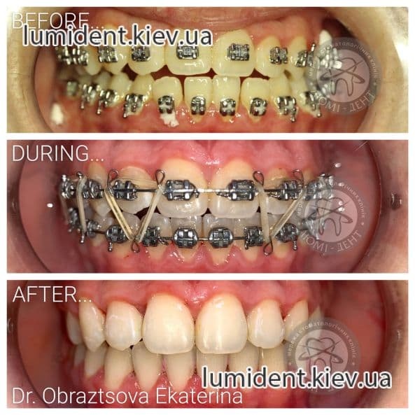 Брекеты на зубы система фото Киев Люми-Дент
