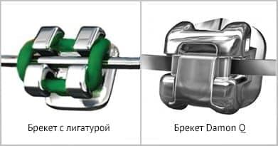 Различие между лигатурным брекетом и безлигатурным Безлигатурные брекет-системы даймон фото Люми-Дент
