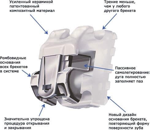 Различие между лигатурным брекетом и безлигатурным Безлигатурные брекет-системы даймон фото Люми-Дент