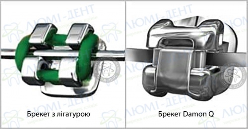 Брекети даймон фото Люмі-Дент
