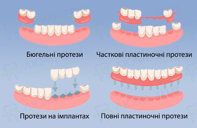 Види зубних протезів фото Люмі-Дент