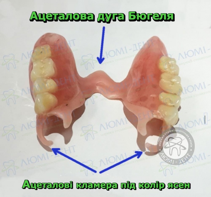 Відгуки про бюгельні протези фото Люмідент
