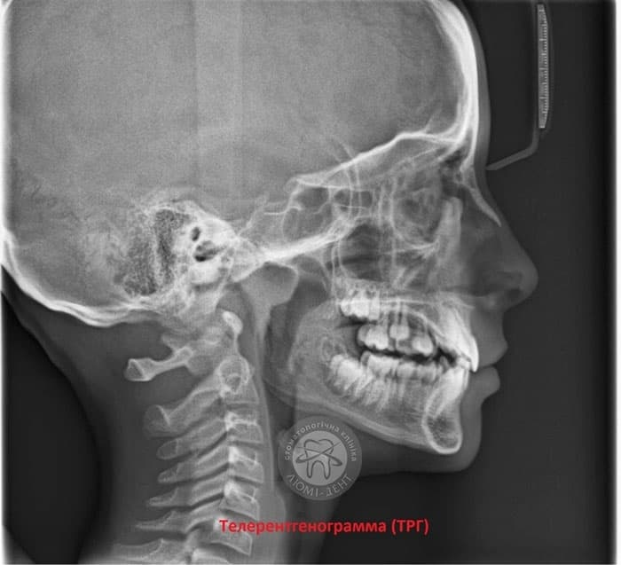 Телерентгенограмма (ТРГ) фото Люми-Дент