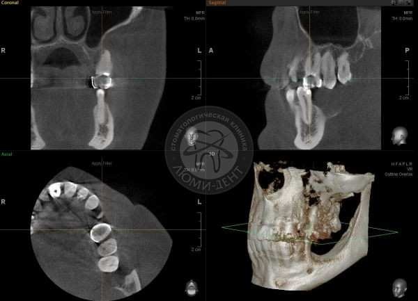 компьютерная томограмма, кт зубов фото Люми-Дент
