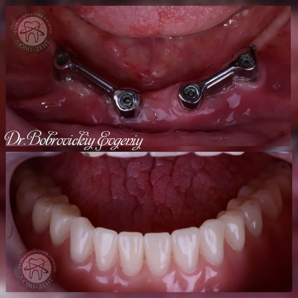 Операція імплантації зубів фото Люмі-Дент