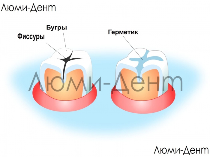 Герметизация фиссур зубов фото Люми-Дент