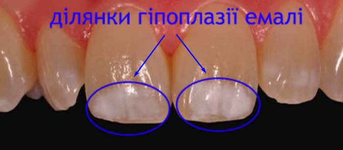 Гіпоплазія емалі зубів фото ЛюміДент