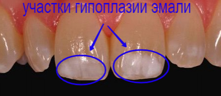 Гипоплазия эмали зубов фото Люми-Дент