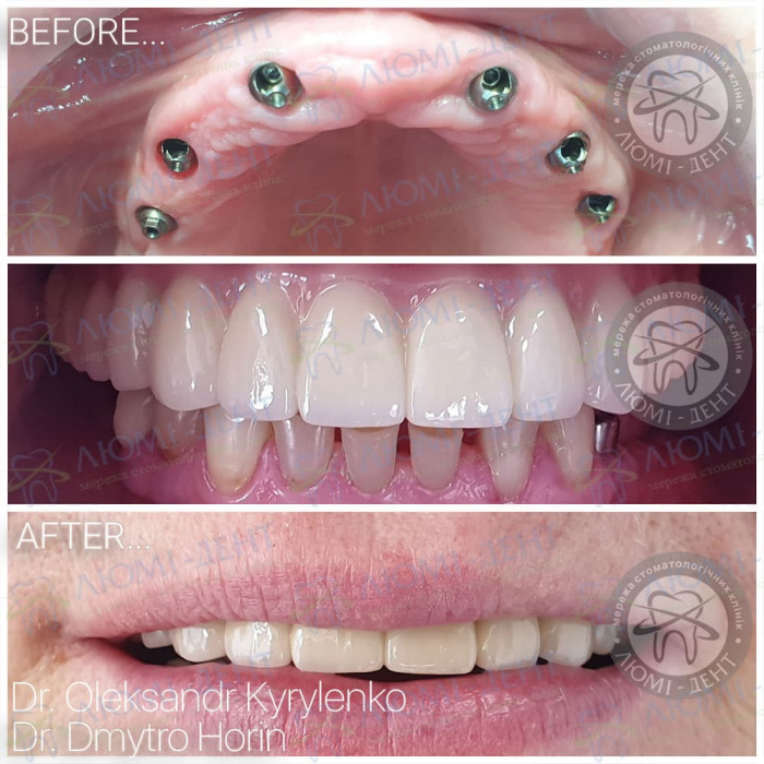 зубні протези при повній відсутності зубів фото Люмі-Дент
