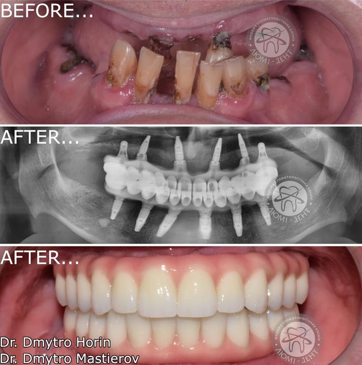 Протезирование зубов цена Киев фото до и после Люми-Дент