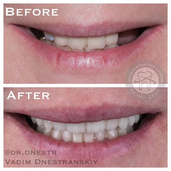 Dental implants implants photo LumiDent