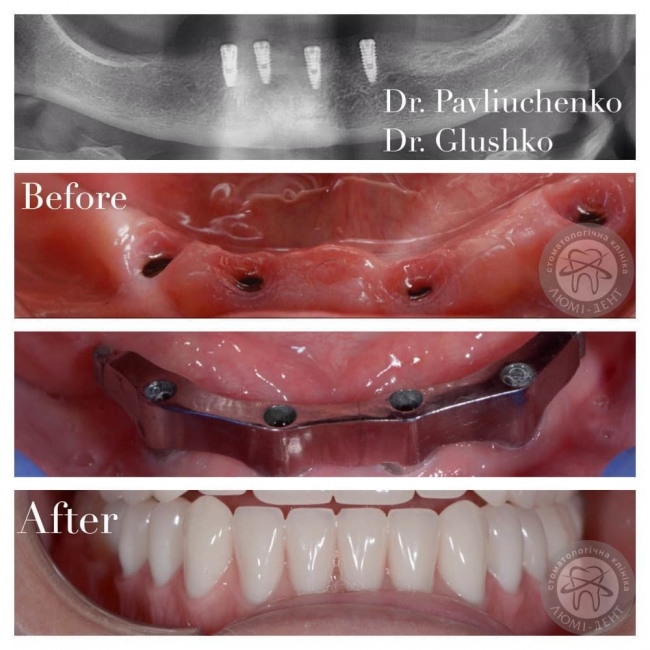 Dental implants teeth photo Lumi-Dent