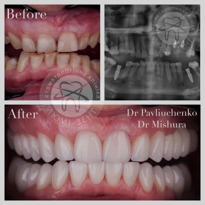 Dental implants photo Lumi-Dent