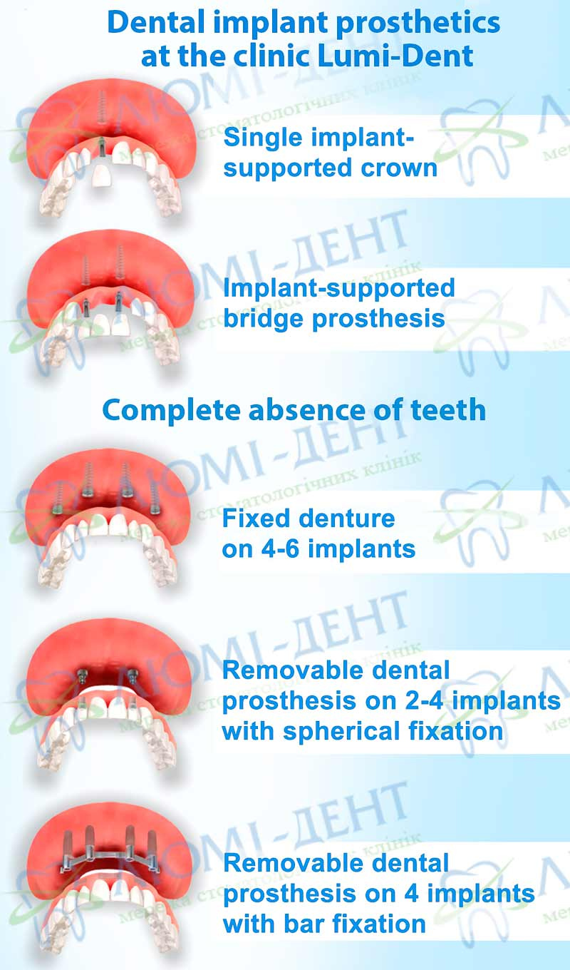 Dental implantation prosthetics photo Lumi-Dent