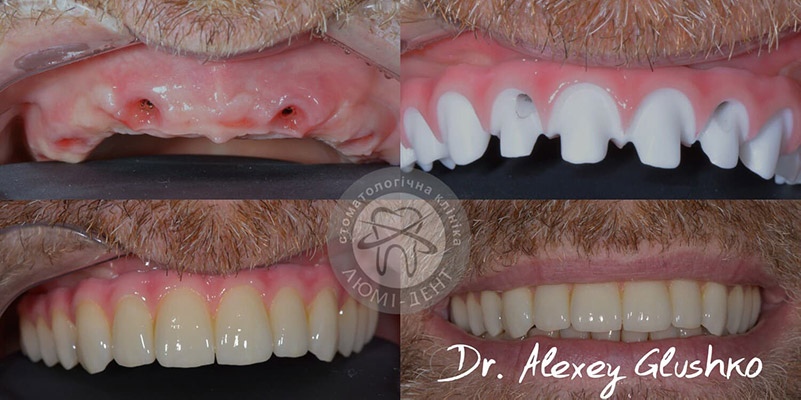 Tooth implantation dental implants photo Lumident